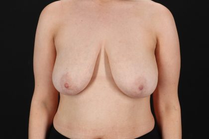Breast Reduction with Lift Before & After Patient #3477