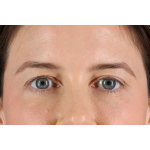 Eyelid Surgery Before & After Patient #3570