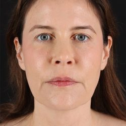 Structural Fat Grafting Before & After Patient #3647