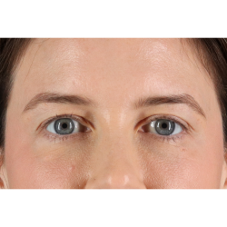 Eyelid Surgery Before & After Patient #3570