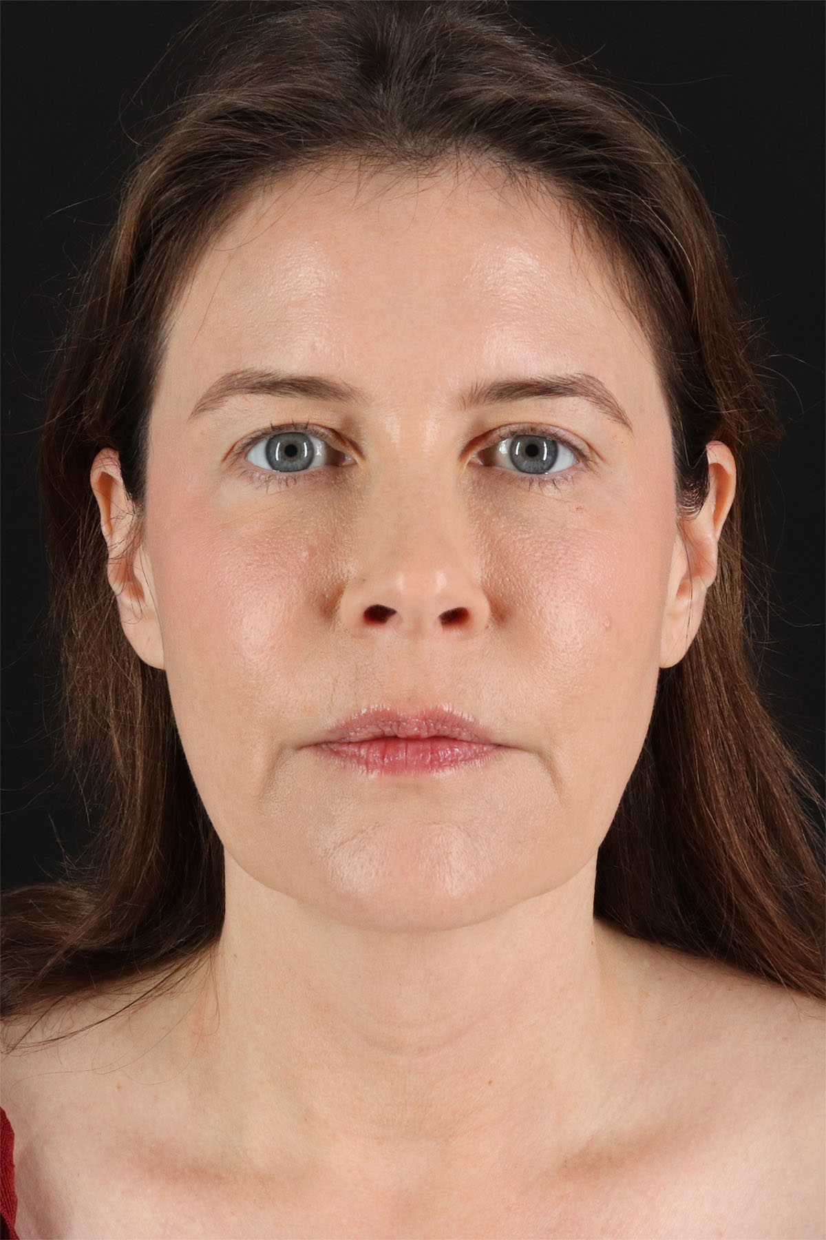 Structural Fat Grafting Before & After Patient #3647