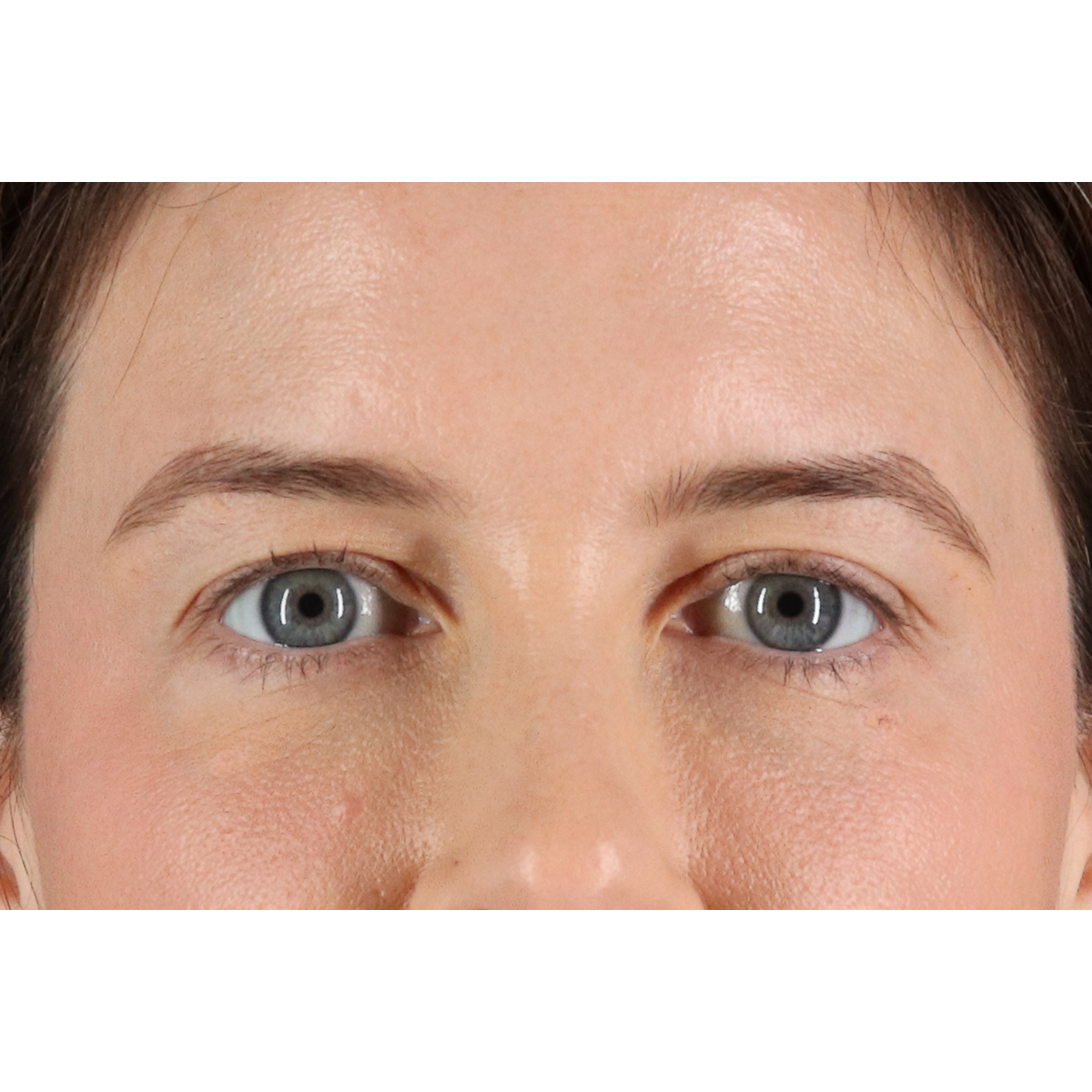 Eyelid Surgery Before & After Patient #3570