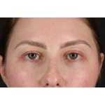 Brow Lift Before & After Patient #3111