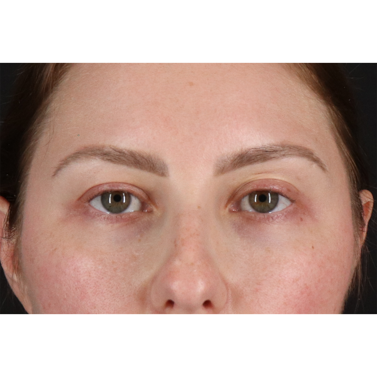 Brow Lift Before & After Patient #3111
