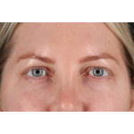 Eyelid Surgery Before & After Patient #3112