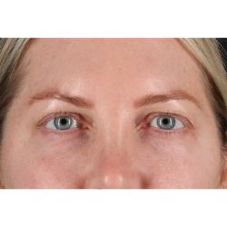 Eyelid Surgery Before & After Patient #3112