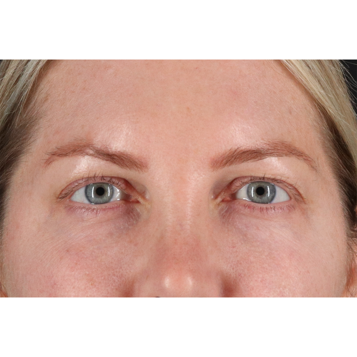 Eyelid Surgery Before & After Patient #3112