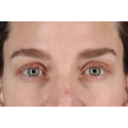 Eyelid Surgery Before & After Patient #3571