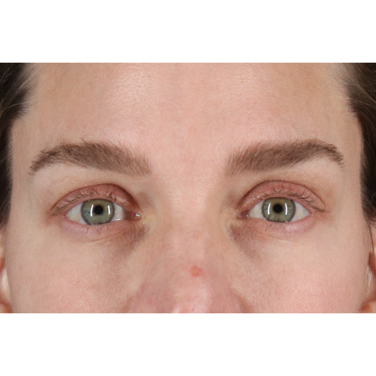 Eyelid Surgery Before & After Patient #3571