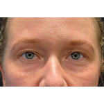 Eyelid Surgery Before & After Patient #3454