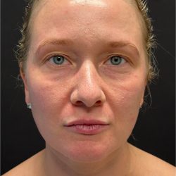 Laser Before & After Patient #3455