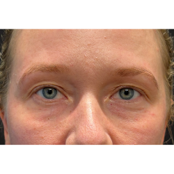 Eyelid Surgery Before & After Patient #3454