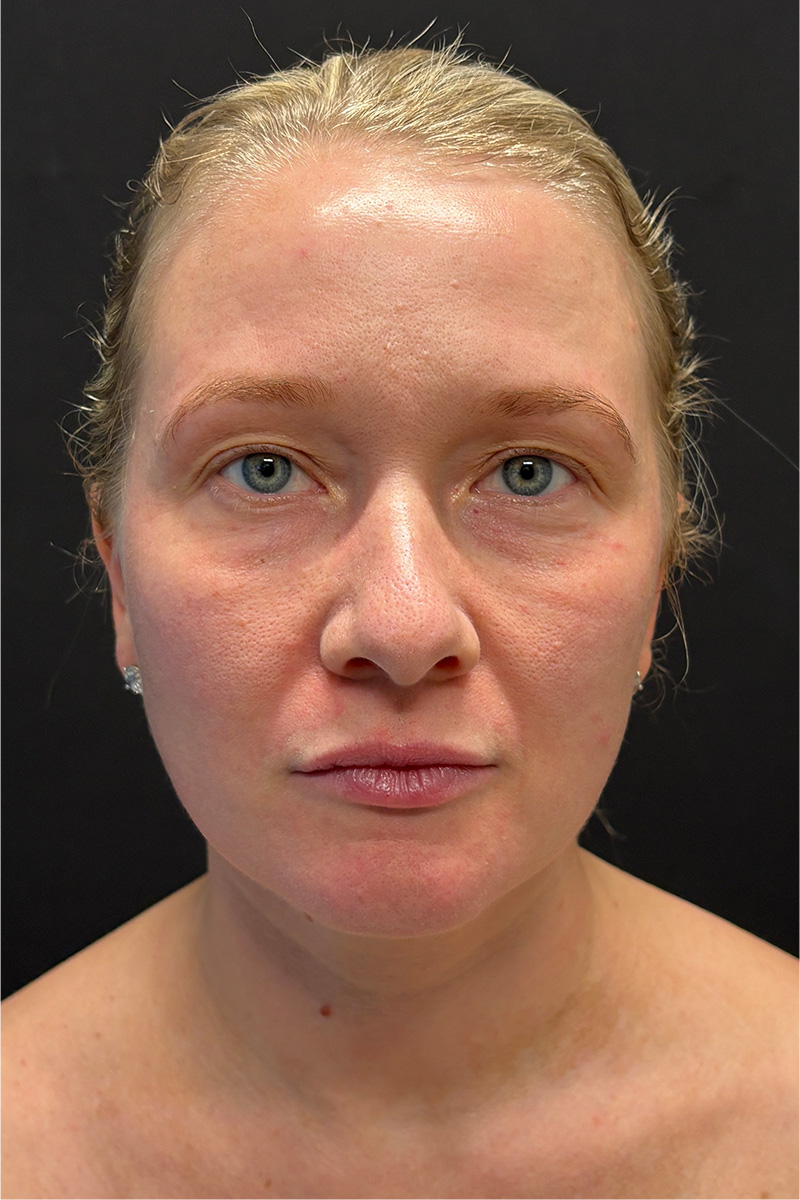 Laser Before & After Patient #3455