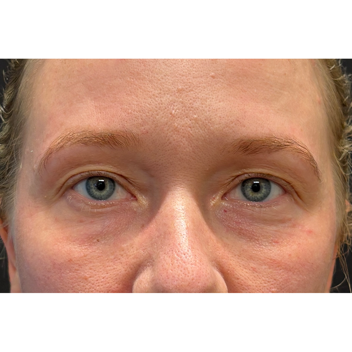 Eyelid Surgery Before & After Patient #3454