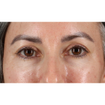 Eyelid Surgery Before & After Patient #3356