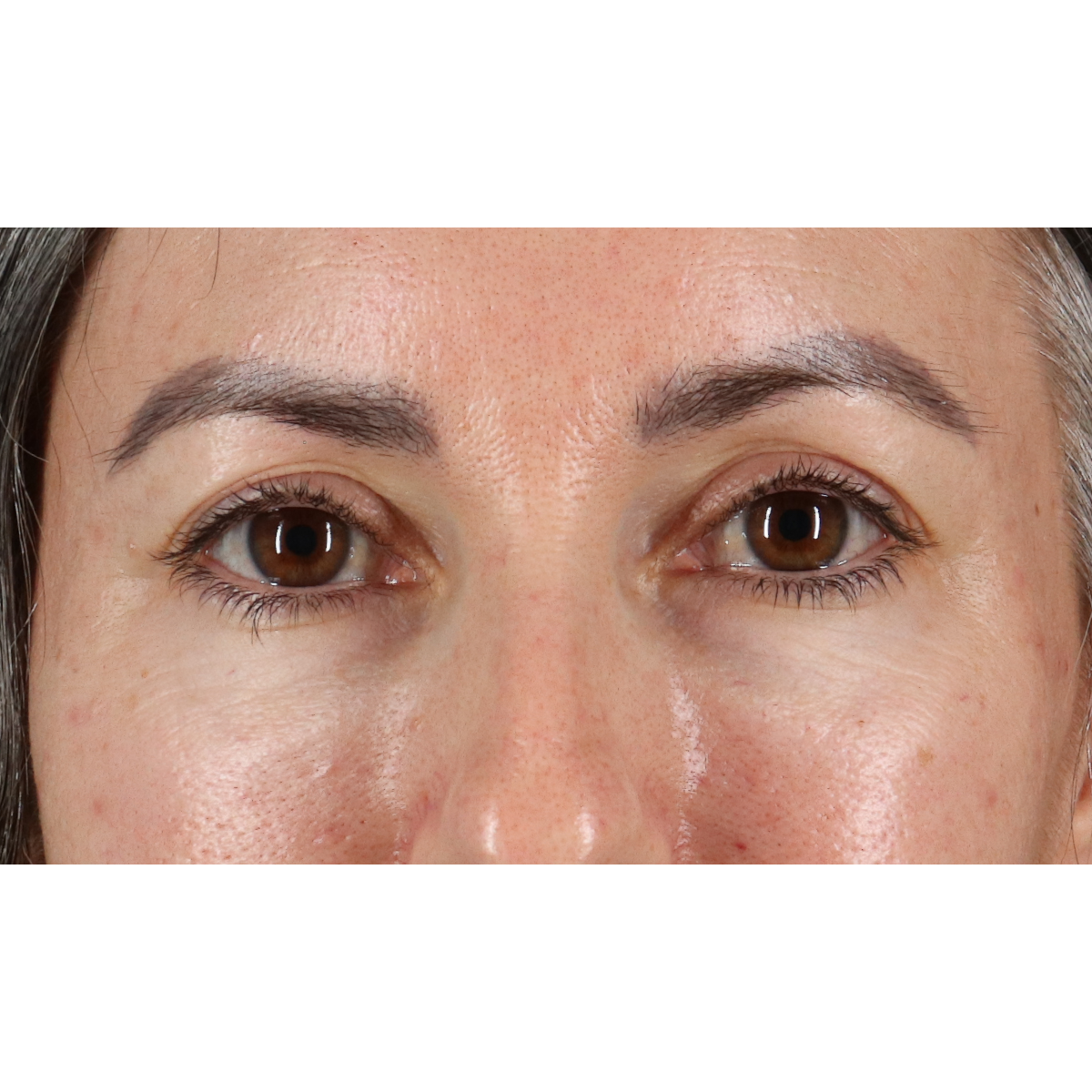 Eyelid Surgery Before & After Patient #3356