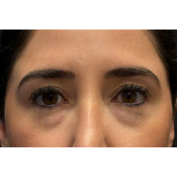 Eyelid Surgery Before & After Patient #3358