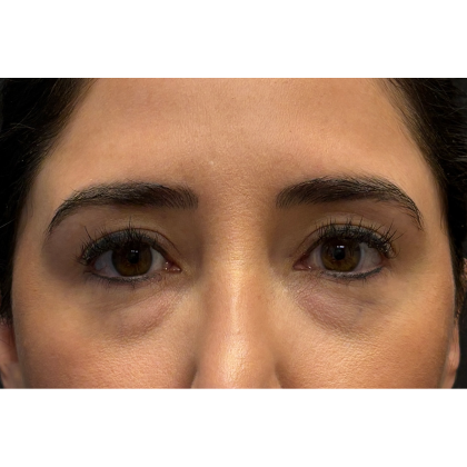Eyelid Surgery Before & After Patient #3358