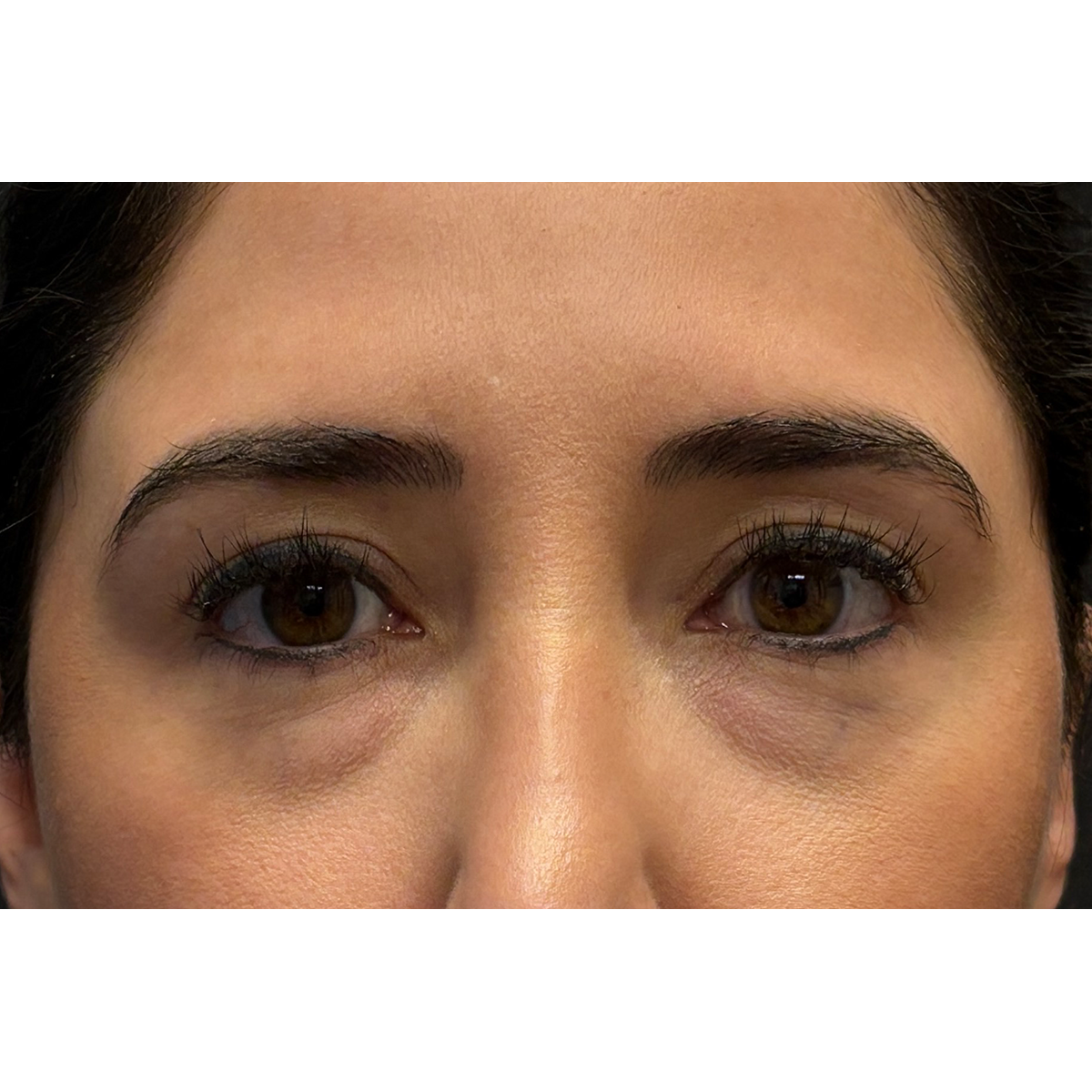 Eyelid Surgery Before & After Patient #3358