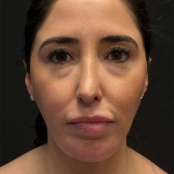 Structural Fat Grafting Before & After Patient #3649