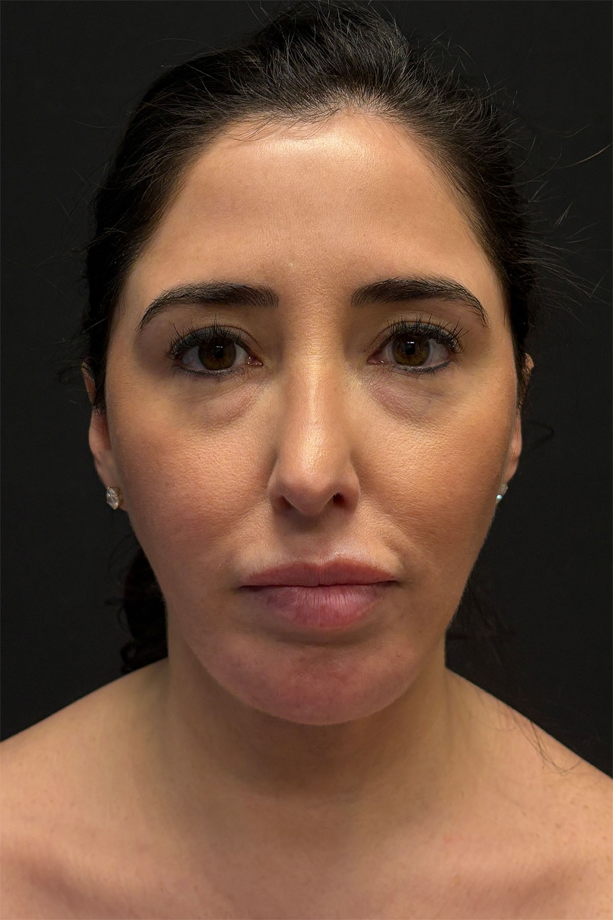 Structural Fat Grafting Before & After Patient #3649