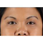 Brow Lift Before & After Patient #3114