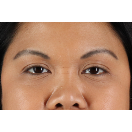 Brow Lift Before & After Patient #3114