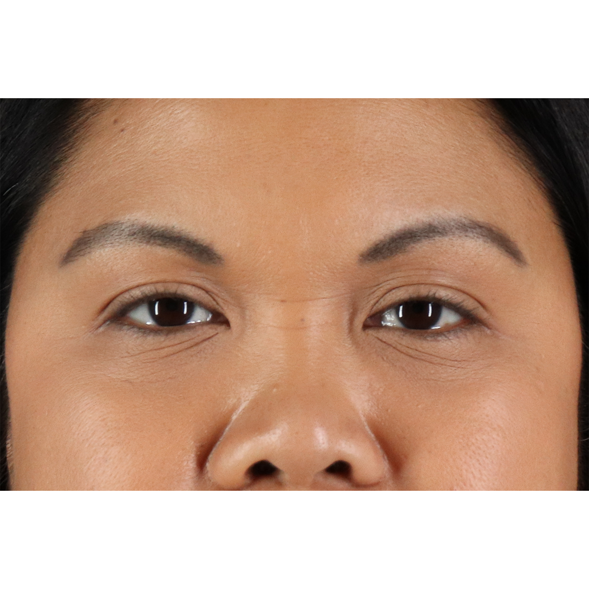 Brow Lift Before & After Patient #3114