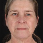 CO2 Laser Before & After Patient #3116
