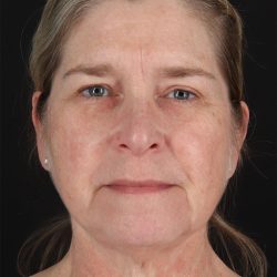 CO2 Laser Before & After Patient #3116