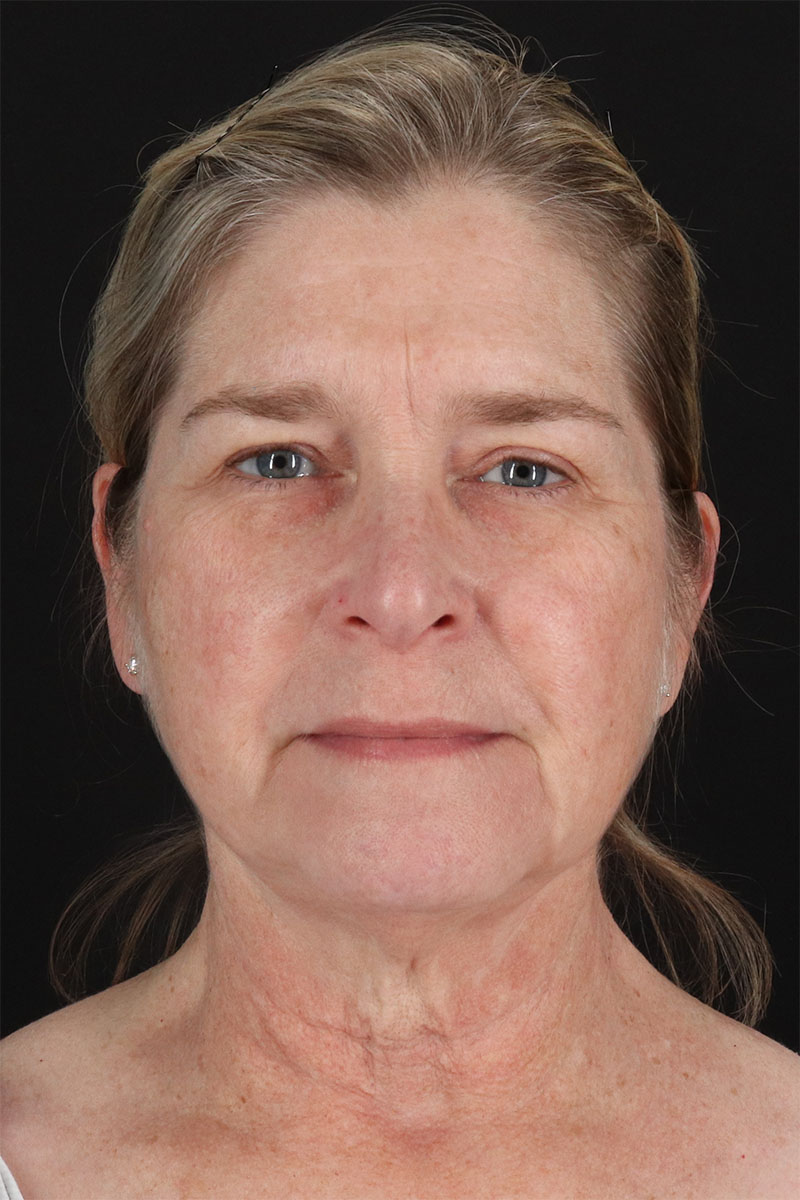 CO2 Laser Before & After Patient #3116