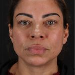 Laser Before & After Patient #3359