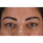 Eyelid Surgery Before & After Patient #3360