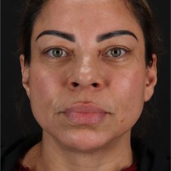 Laser Before & After Patient #3359