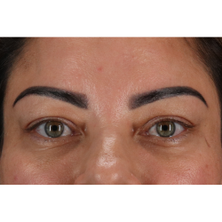 Eyelid Surgery Before & After Patient #3360