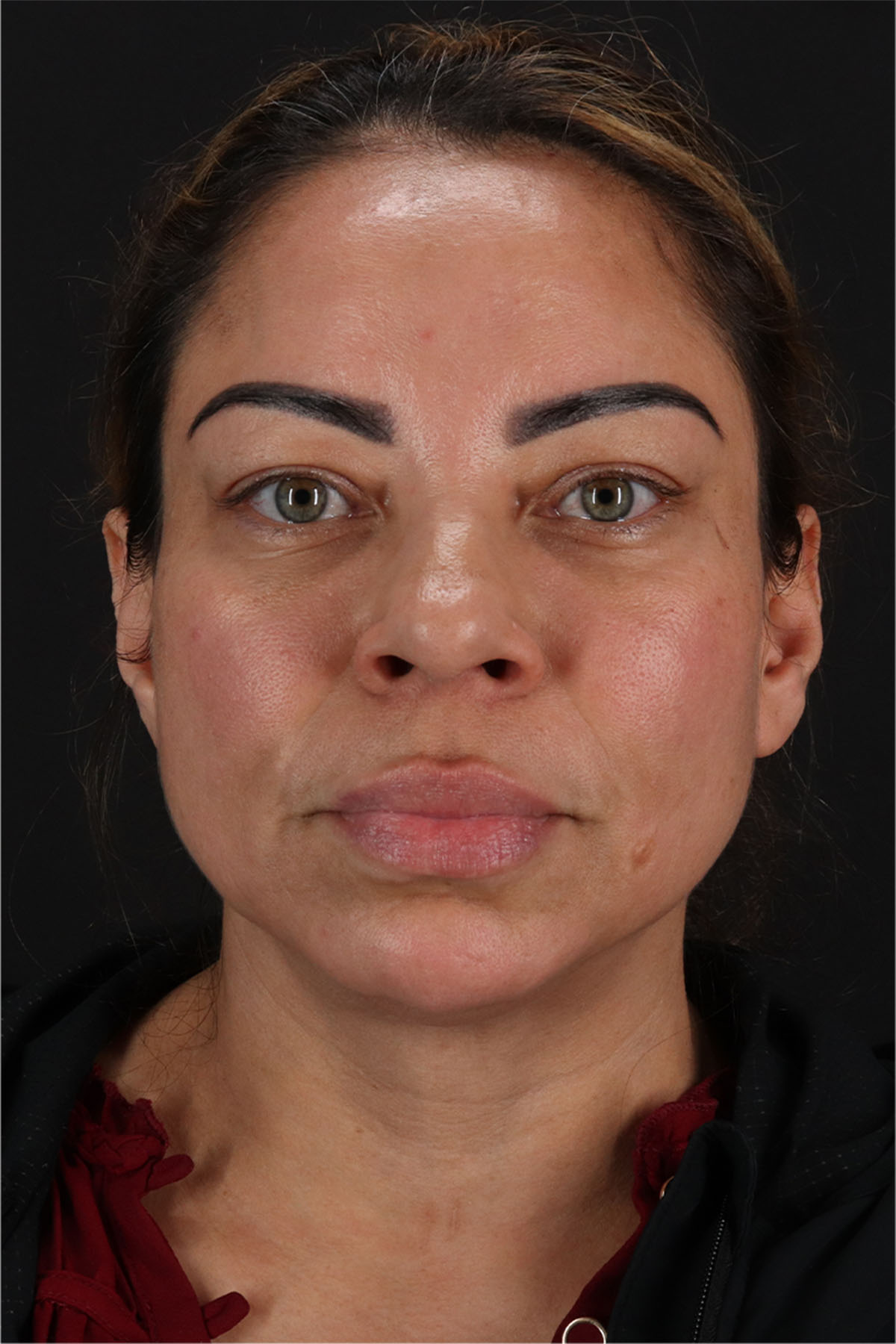 Laser Before & After Patient #3359