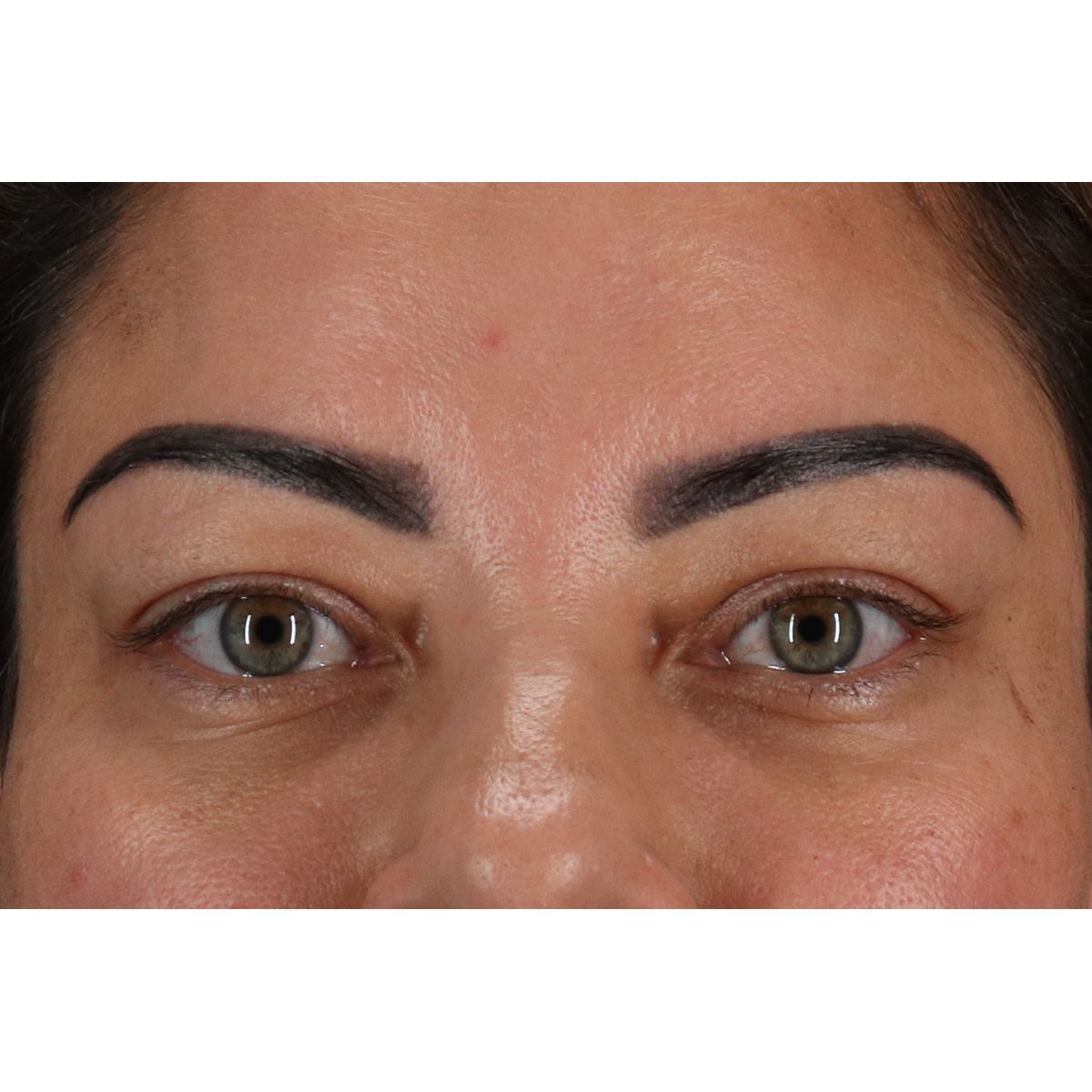 Eyelid Surgery Before & After Patient #3360