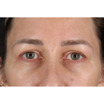Eyelid Surgery Before & After Patient #3361