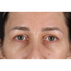 Eyelid Surgery Before & After Patient #3361