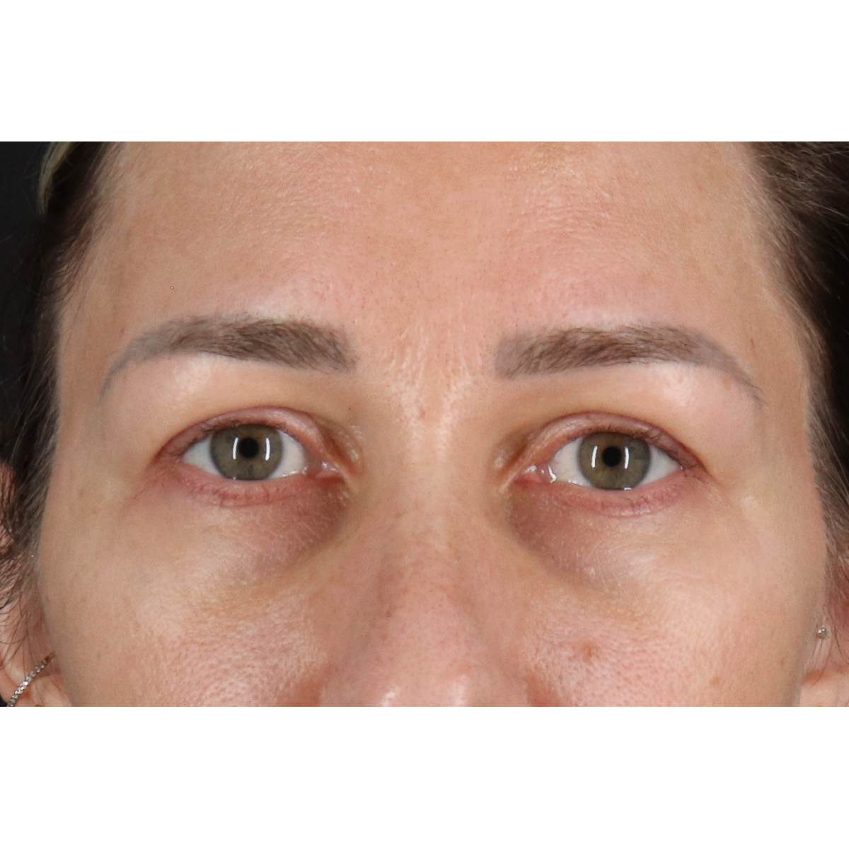 Eyelid Surgery Before & After Patient #3361