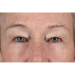 Eyelid Surgery Before & After Patient #3363