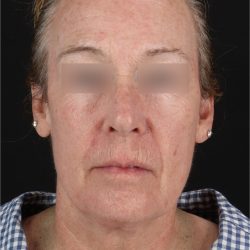 Laser Before & After Patient #3362