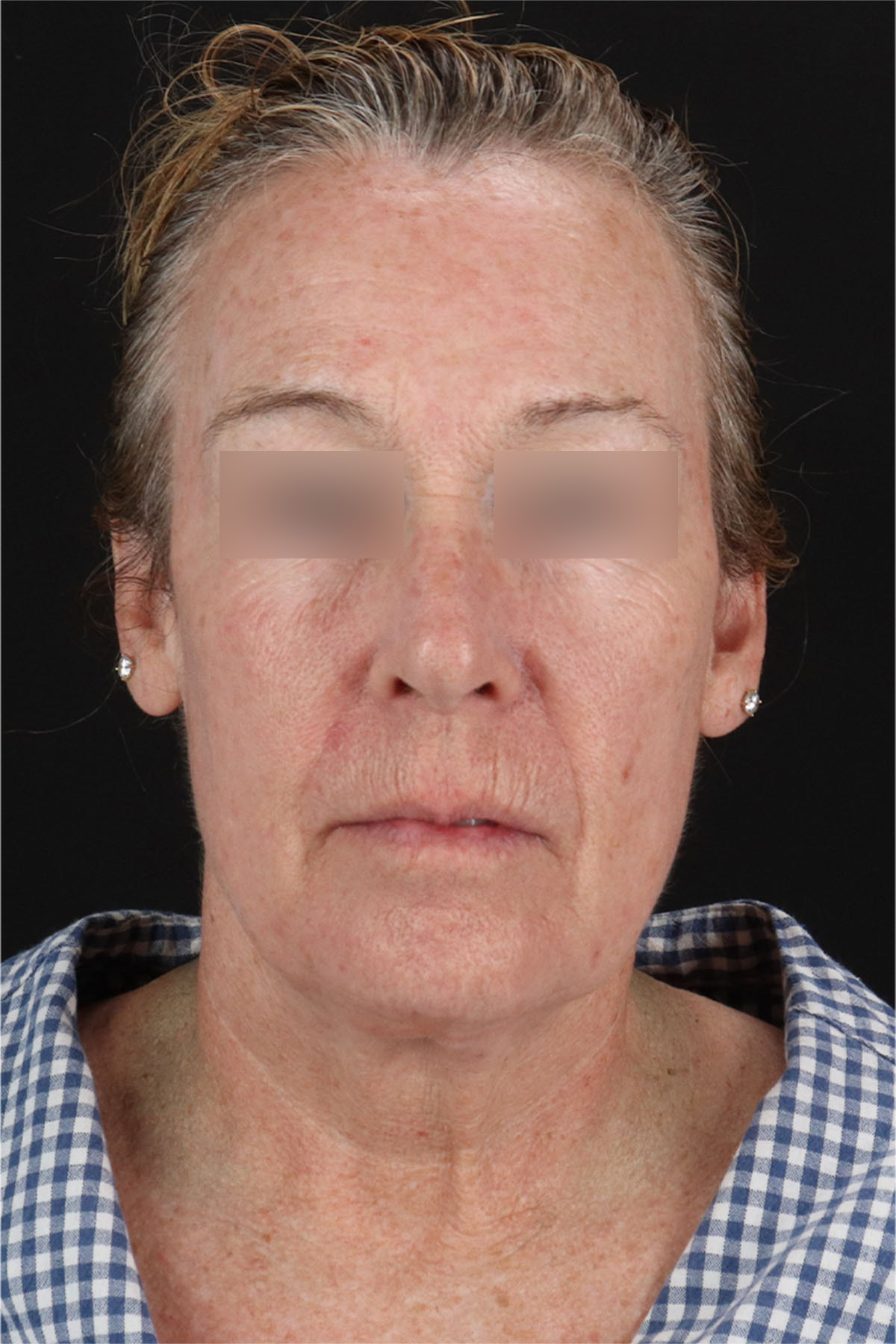 Laser Before & After Patient #3362