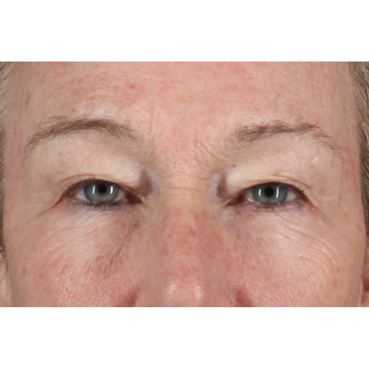 Eyelid Surgery Before & After Patient #3363