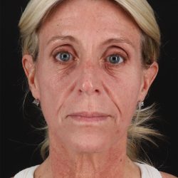 Ponytail Facelift Before & After Patient #3118