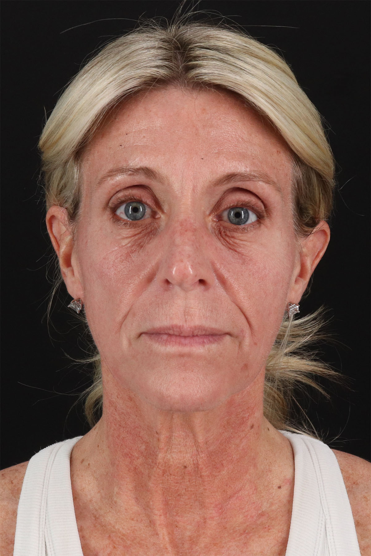 Ponytail Facelift Before & After Patient #3118