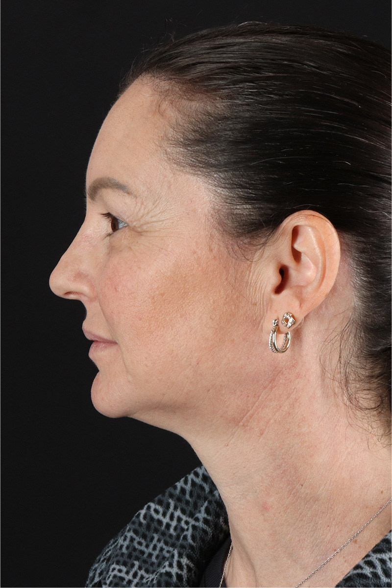 Chemical Peel Before & After Patient #3470