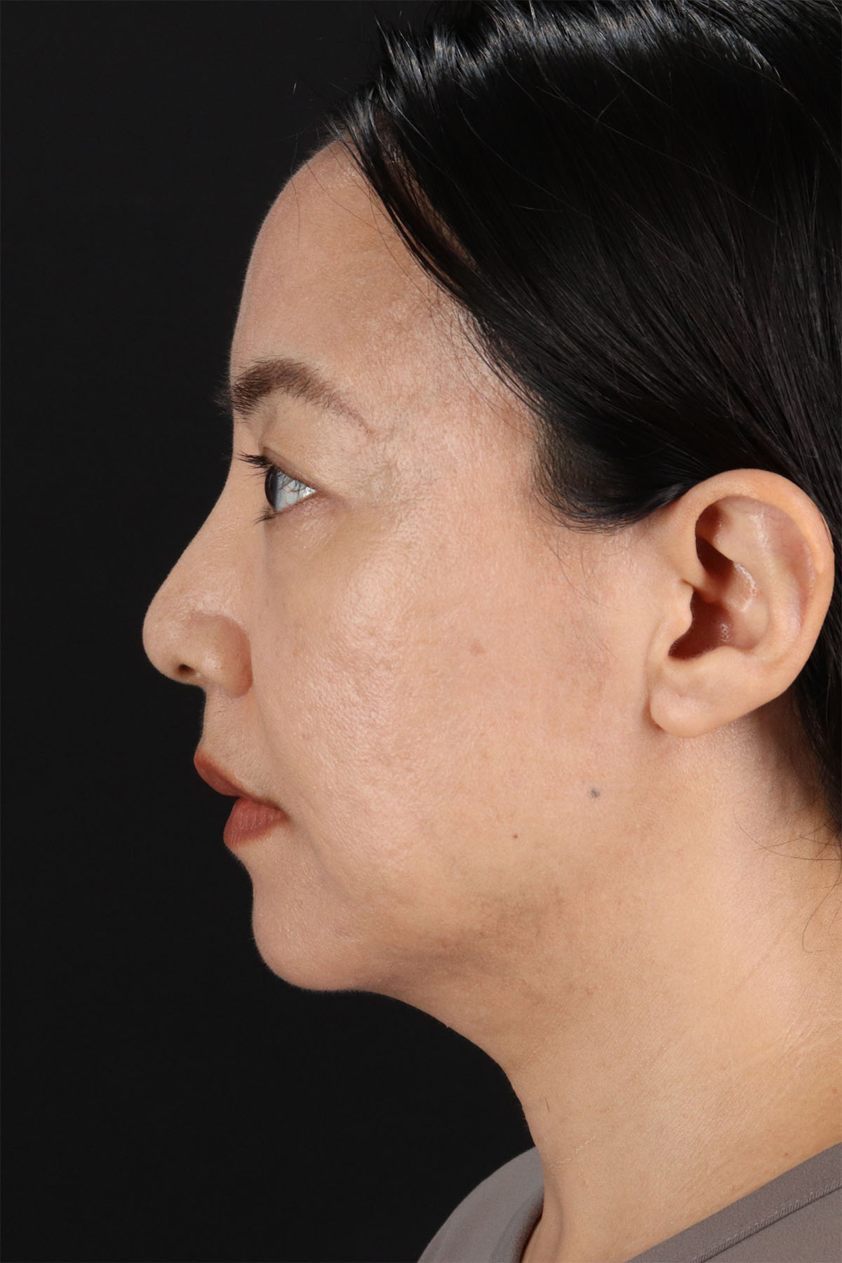Skin Resurfacing / Laser Before & After Patient #3001