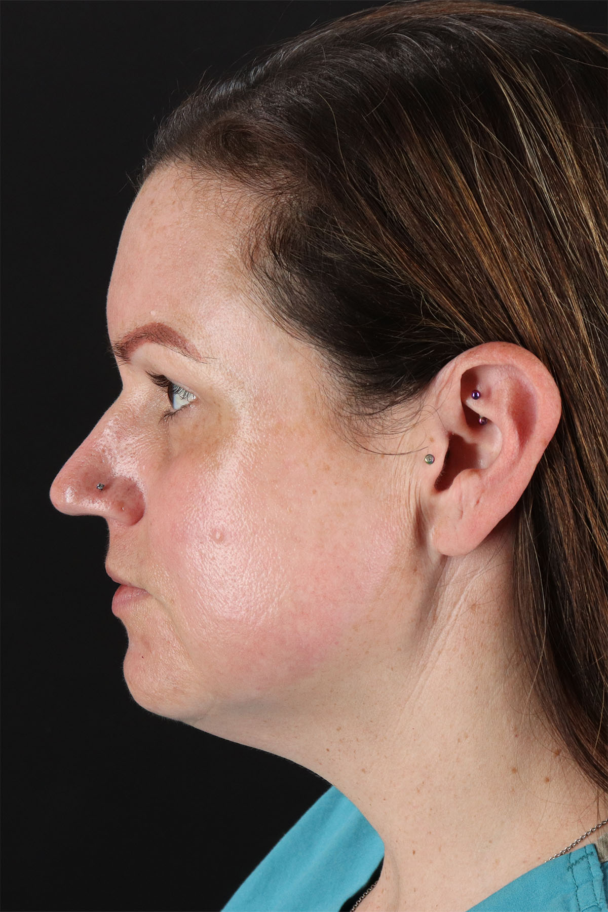 Chemical Peel Before & After Patient #3002
