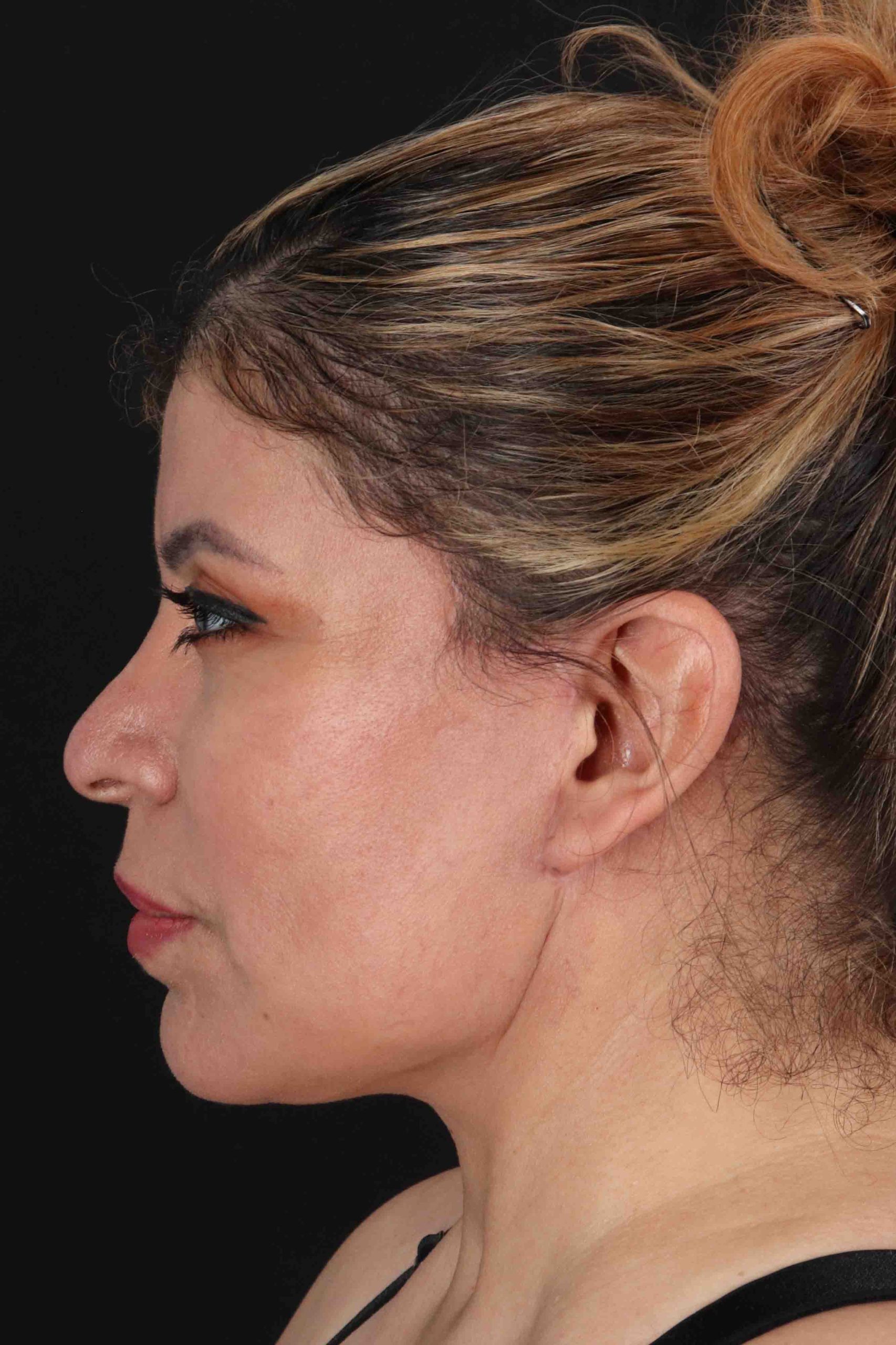Structural Fat Grafting Before & After Patient #3642
